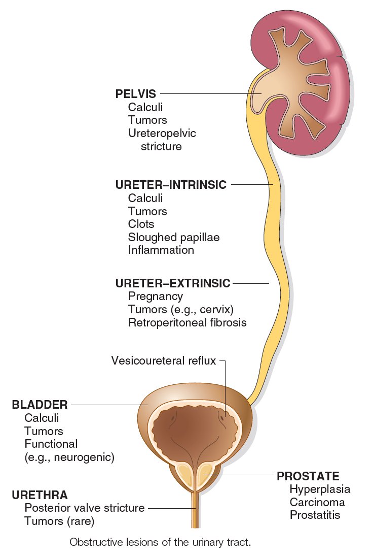 Obstructive Uropathy Image