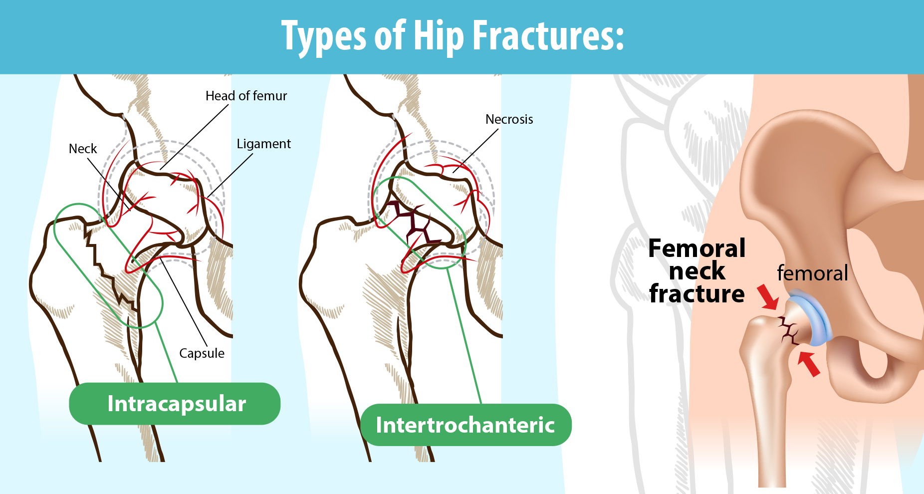 Intracapsular Fracture Diagram