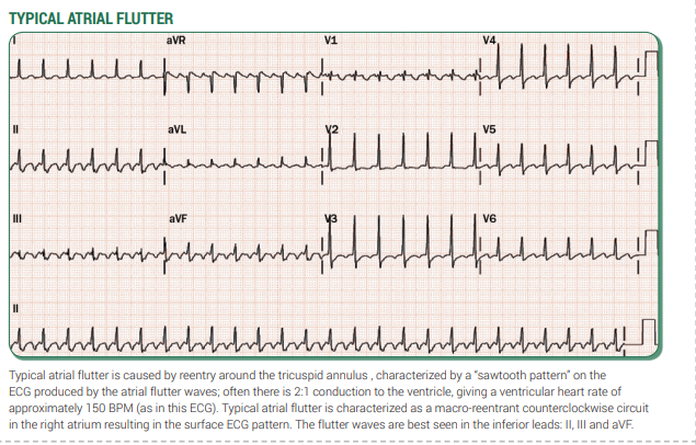 SVT Example