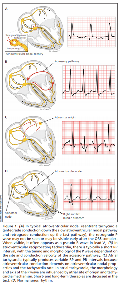 SVT ECG Example