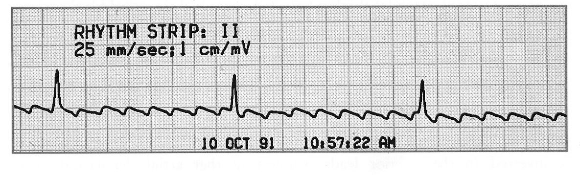 ECG Atrial Flutter 1