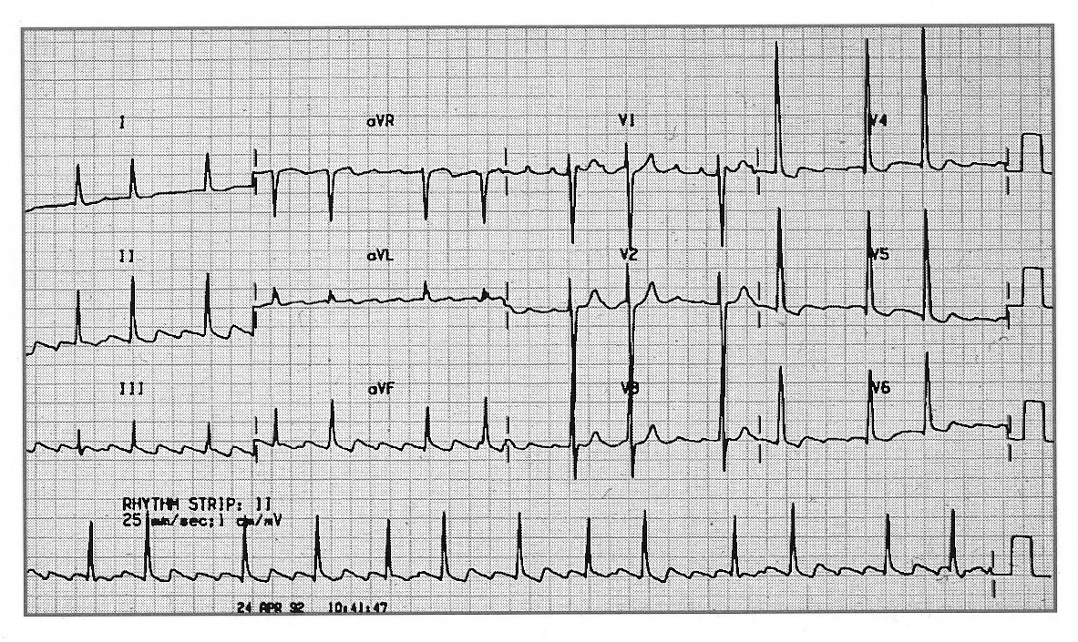 ECG Atrial Flutter 2