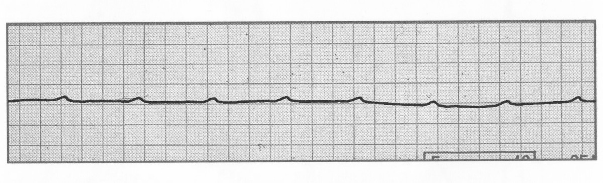 P-wave asystole