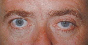 Clinical Signs of Horner's