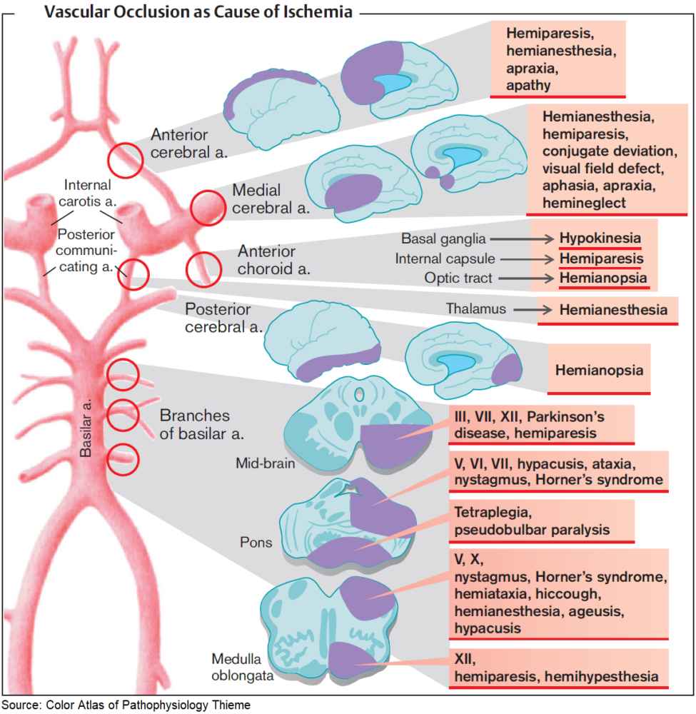 Stroke symptoms by vascular territory