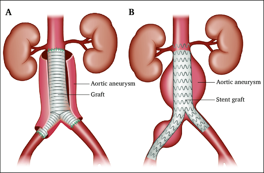 AAA Surgical Procedure