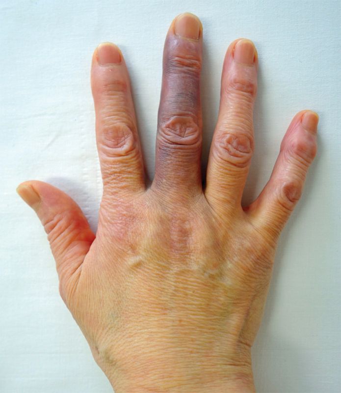 Achenbach’s syndrome illustration