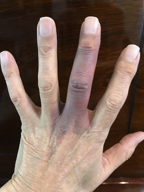Achenbach’s syndrome clinical image