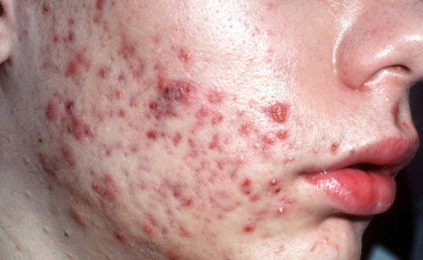 Acne Image 1