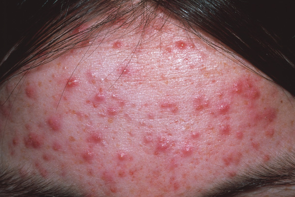 Acne Image 2