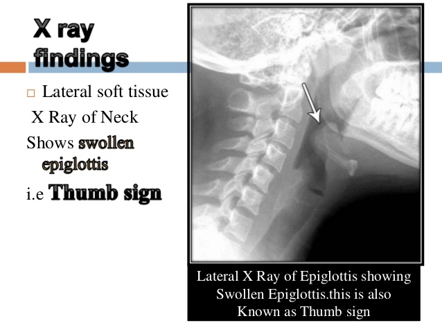 Acute Epiglottitis