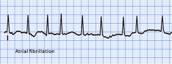 AF ECG