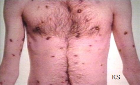 AIDS patient with skin lesions