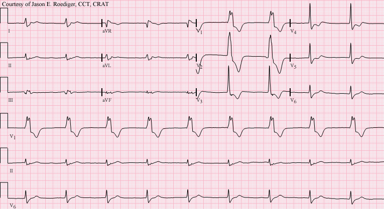 ECG Image of AIVR