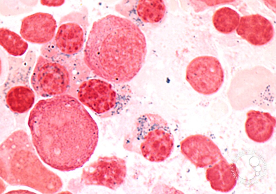 Sideroblastic Anaemia