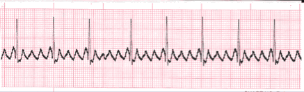 Atrial Flutter Example