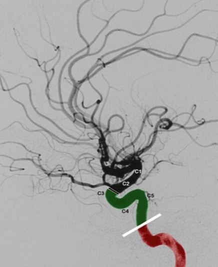 Carotid artery diagram 2