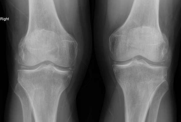 Chondrocalcinosis example