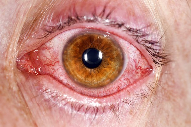 Conjunctivitis