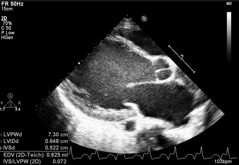 Severe dilation of heart chambers in DCM