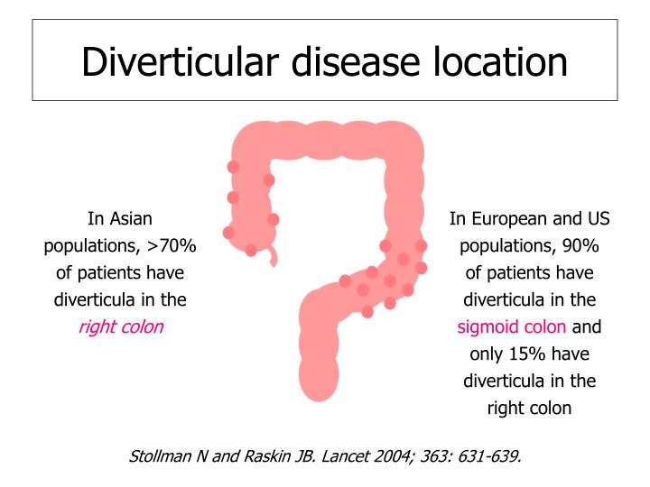 Diverticular Disease Illustration
