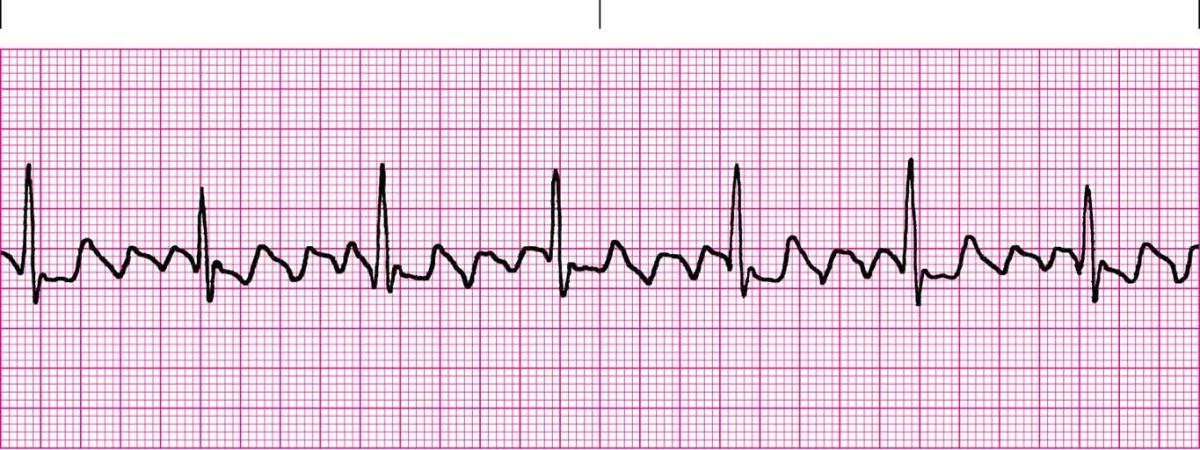 ECG Atrial Flutter 3
