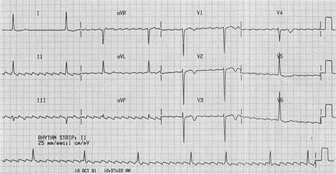 ECG Atrial Flutter 4