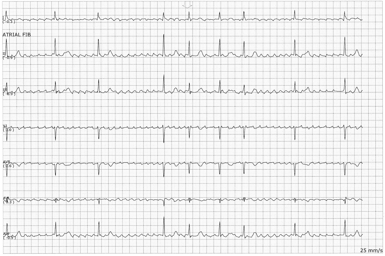 ECG Atrial Flutter 5