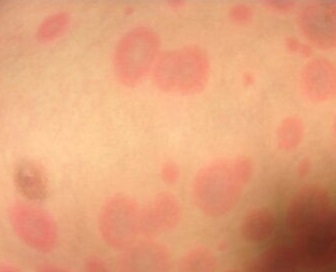 Erythema Multiforme Target Lesion