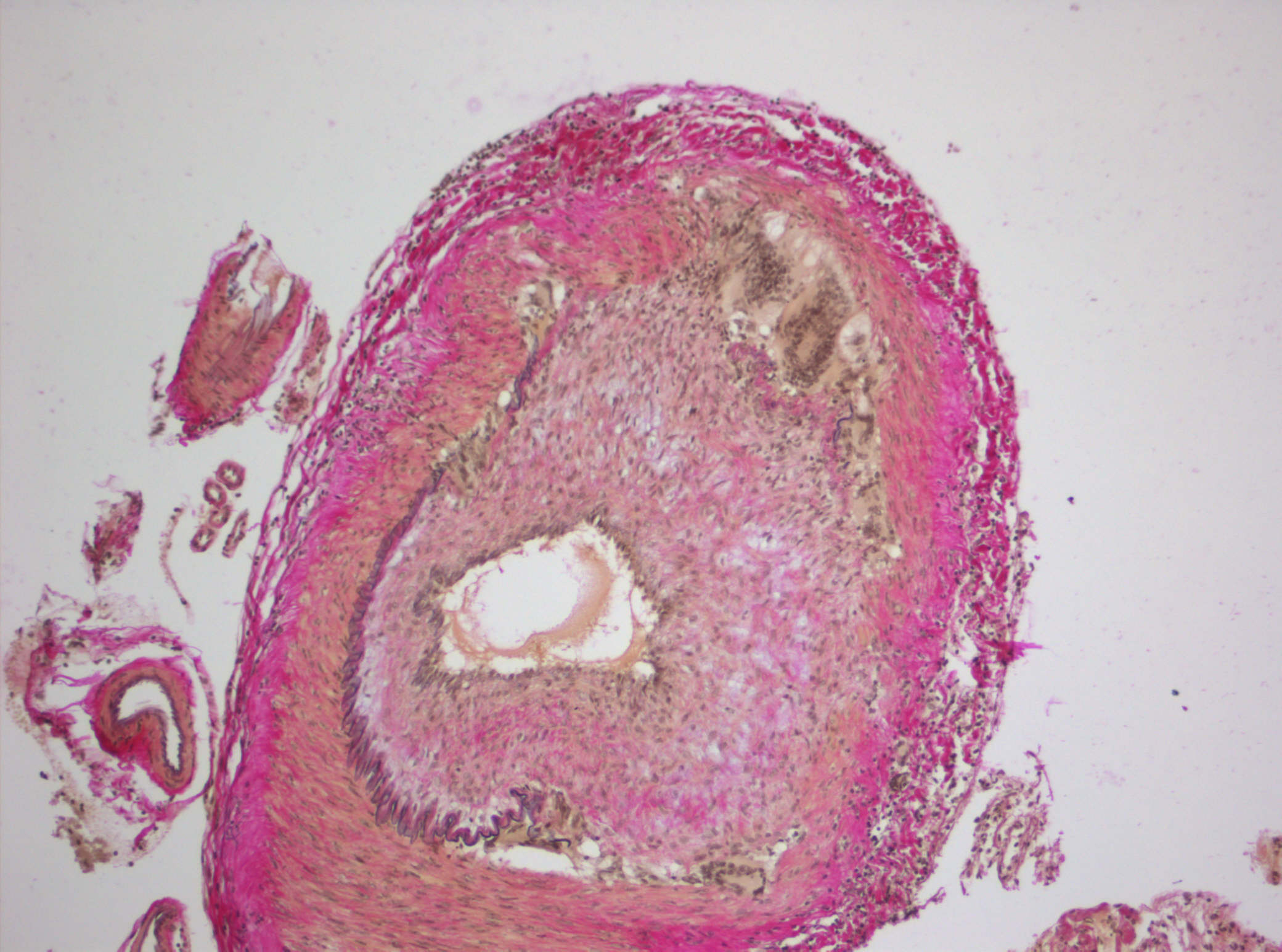 Giant Cell Arteritis Image