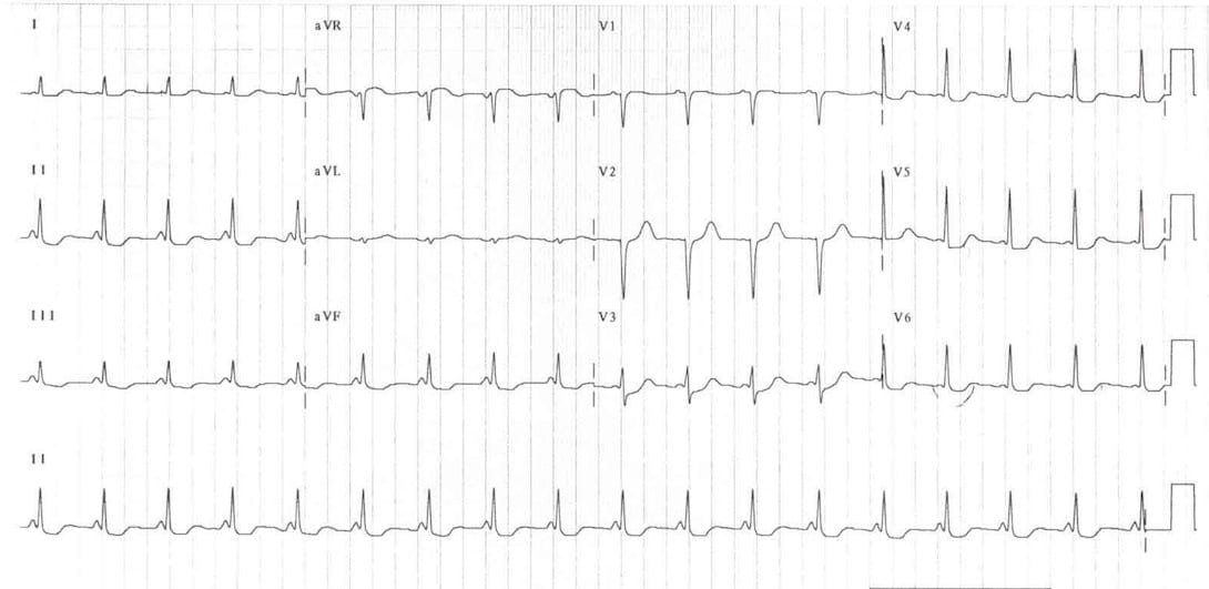 LGL Syndrome ECG