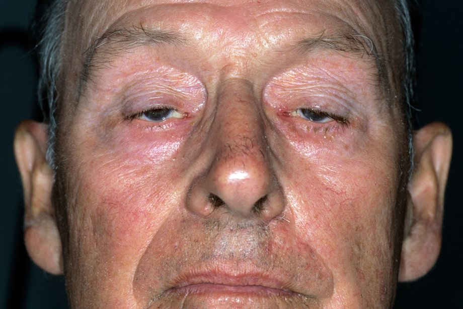 MG Clinical Features Image