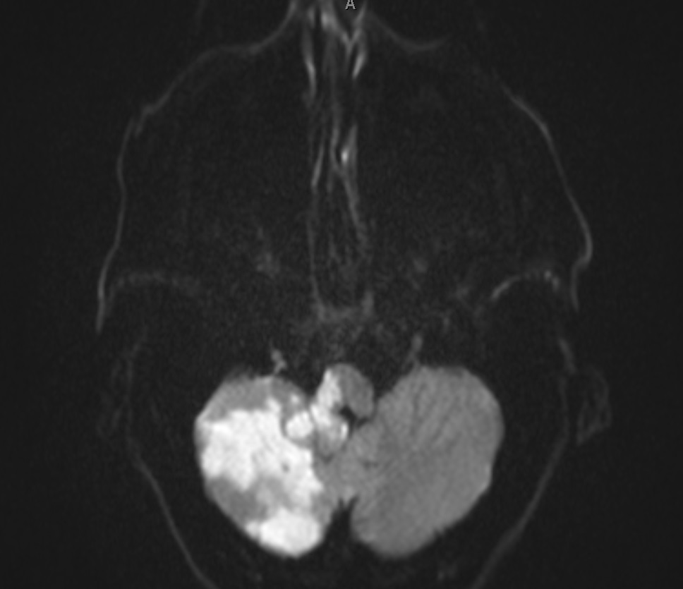 MRI Lateral Medullary Syndrome