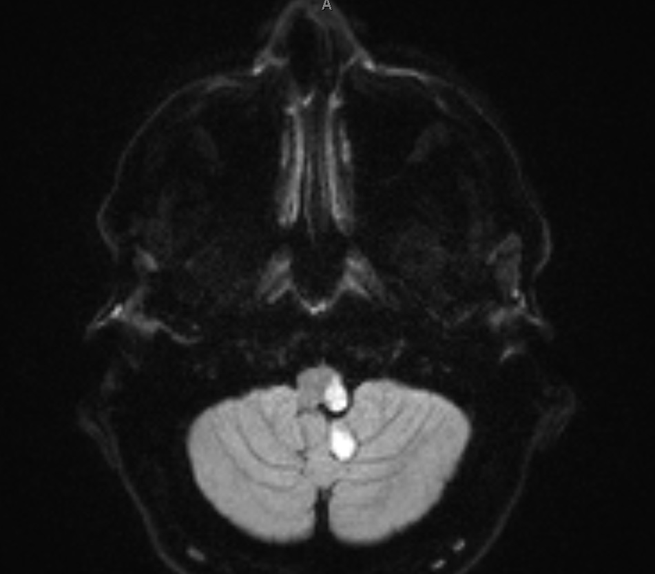 MRI Lateral Medullary Syndrome