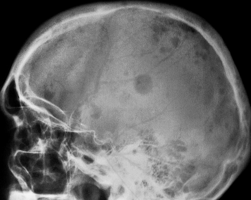 Myeloma skeletal lesions