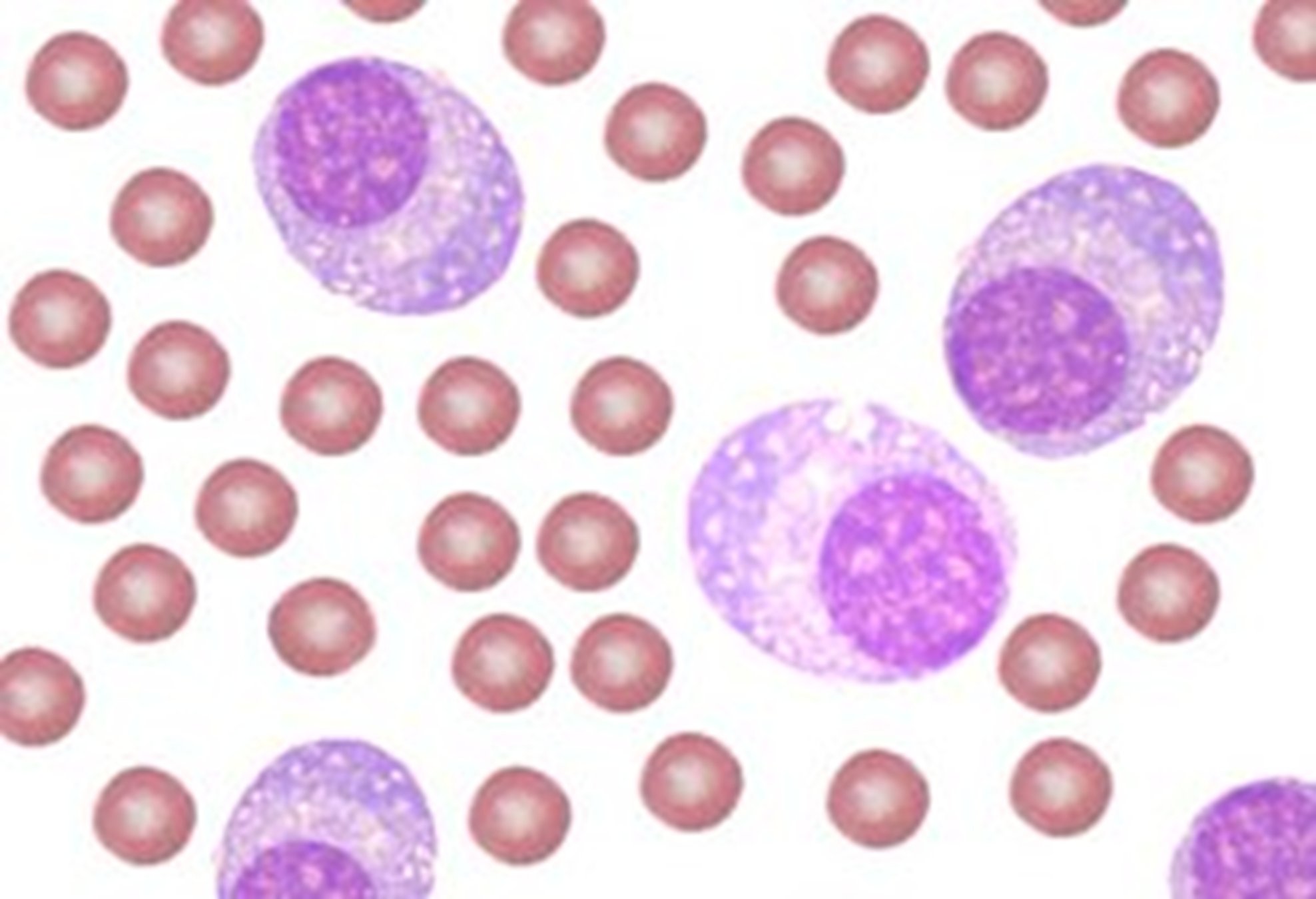 Myeloma bone lesions