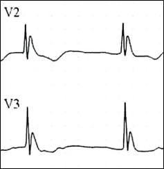 ECG with Osborne Waves