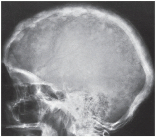 Cotton Wool Skull Appearance in Paget's Disease