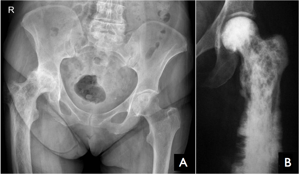 Further Imaging of Cotton Wool Skull in Paget's Disease