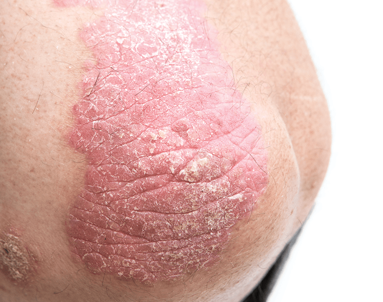 Psoriatic plaque over extensor surface of elbow