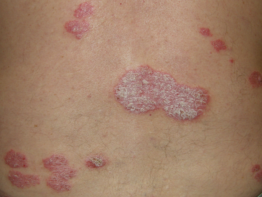 Psoriatic plaque on lower back