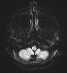 MRI Lateral Medullary Syndrome