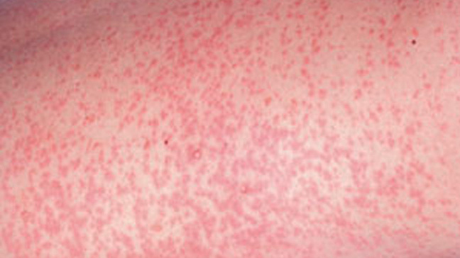 Rubella Rash