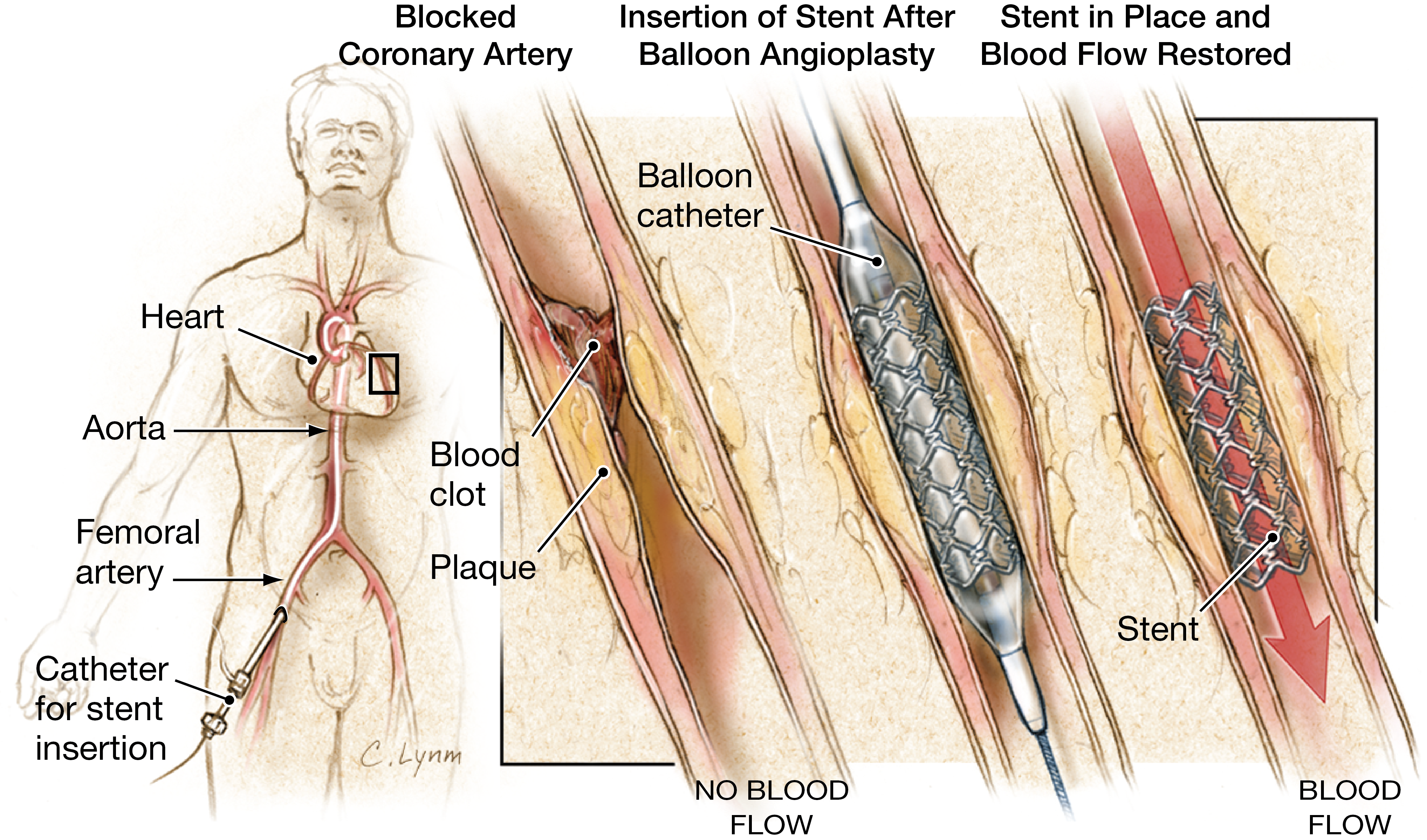 Stent Image