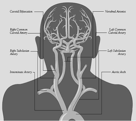 Stroke diagram - blood supply to the brain