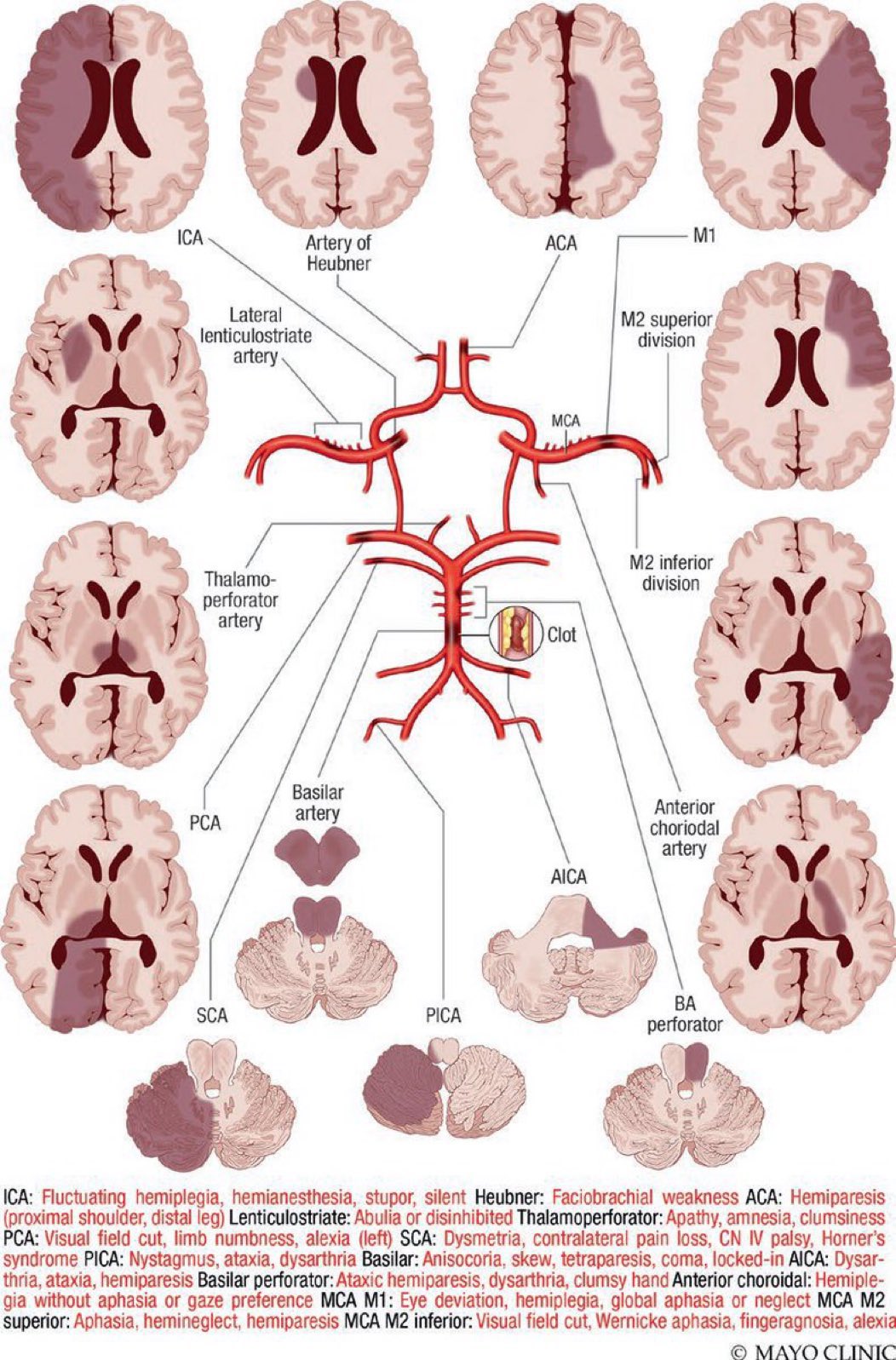 Stroke and brain perfusion