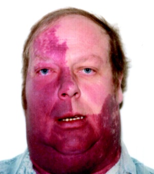 Sturge-Weber Syndrome