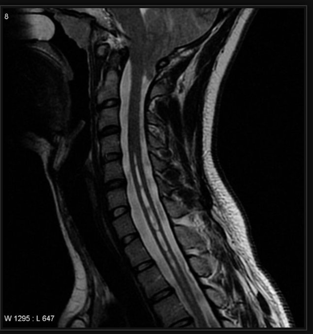 Syrinx in the spinal cord