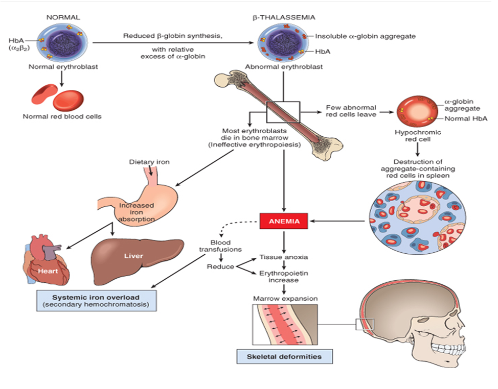 Beta Thalassemia Electrophoresis Pattern