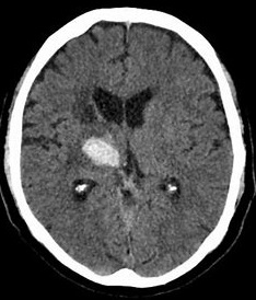 Thalamic Haemorrhage Image